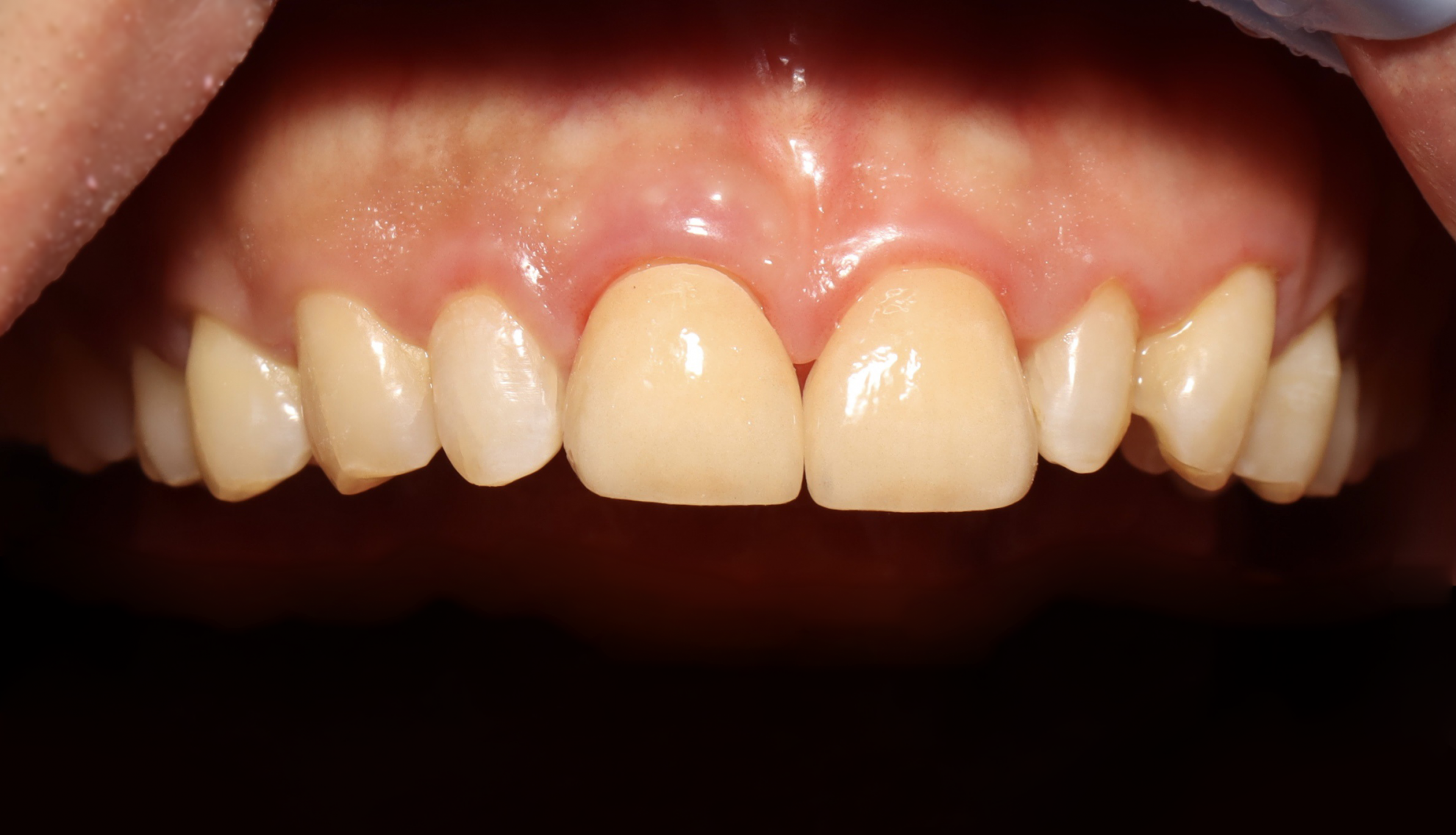 前牙貼片-門牙關縫 郭子睿醫師