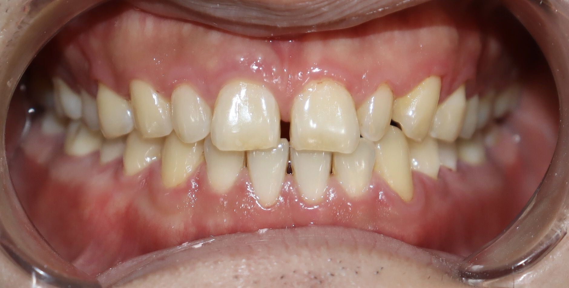 前牙貼片-門牙關縫 郭子睿醫師