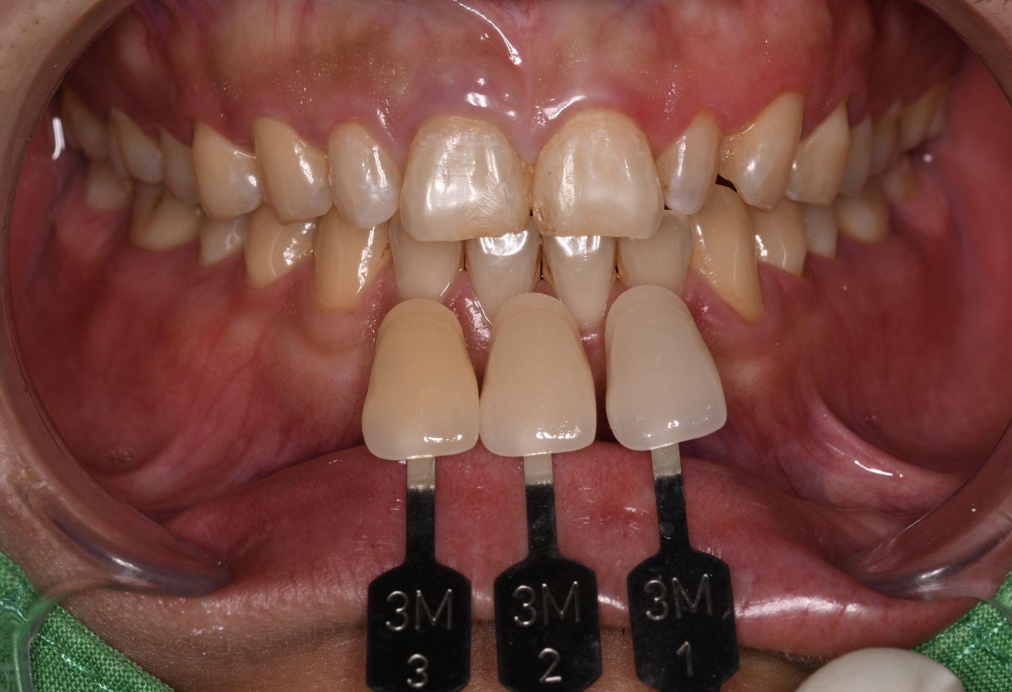 前牙貼片-門牙關縫 郭子睿醫師