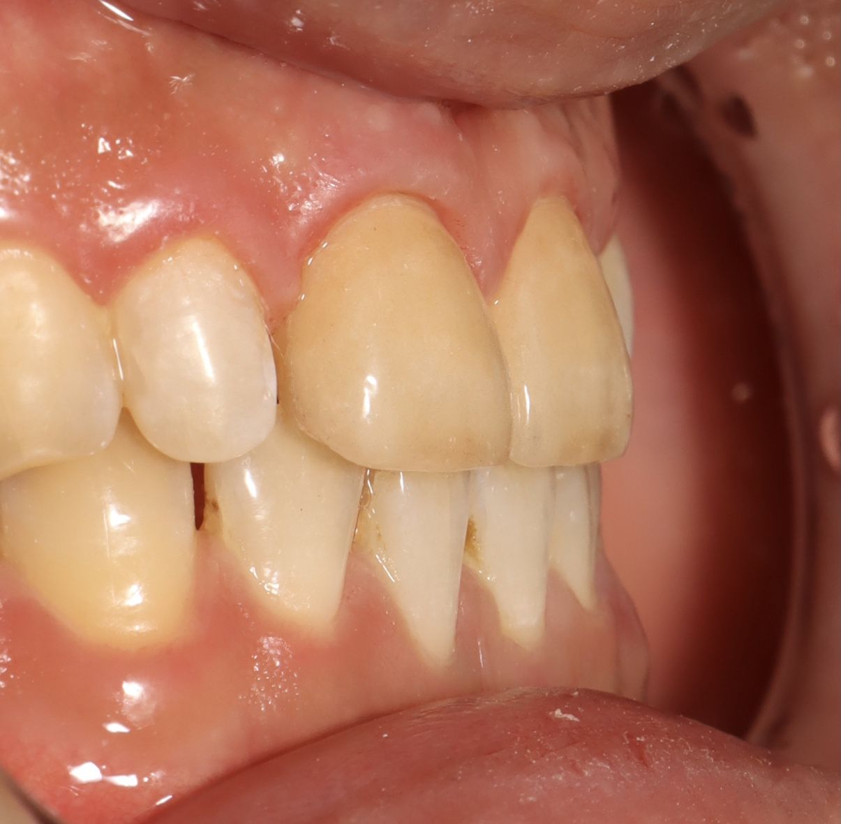 前牙貼片-門牙關縫 郭子睿醫師