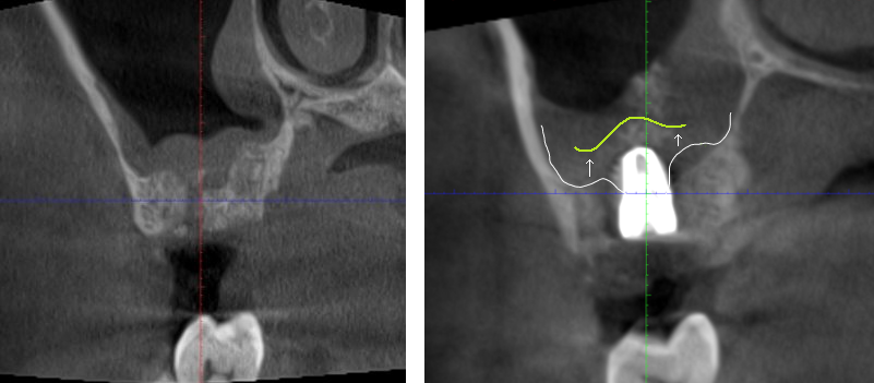 植牙合併上顎竇增高 郭子睿醫師