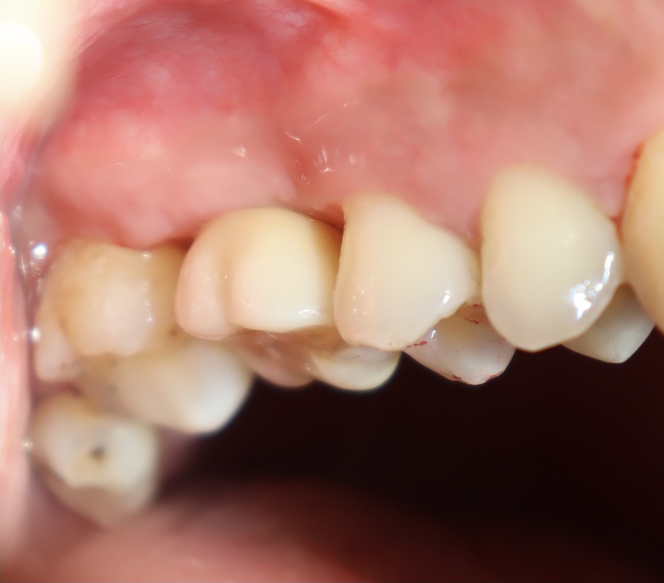 植牙合併上顎竇增高 郭子睿醫師