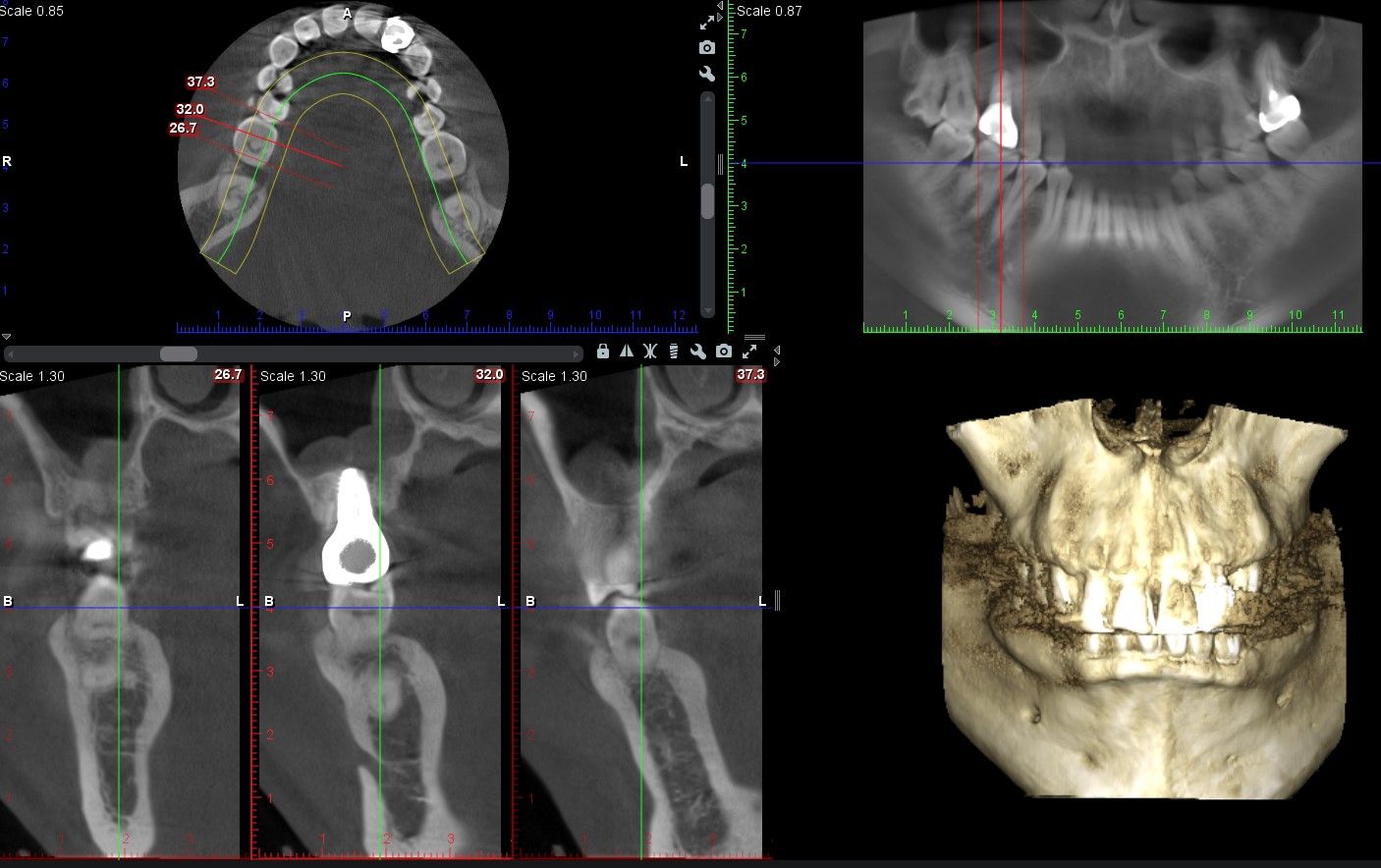 植牙合併上顎竇增高 郭子睿醫師