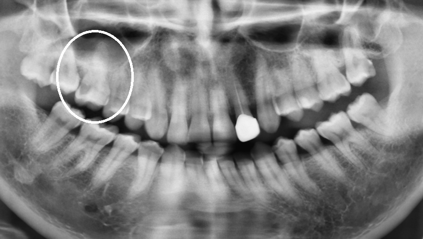 植牙合併上顎竇增高 郭子睿醫師