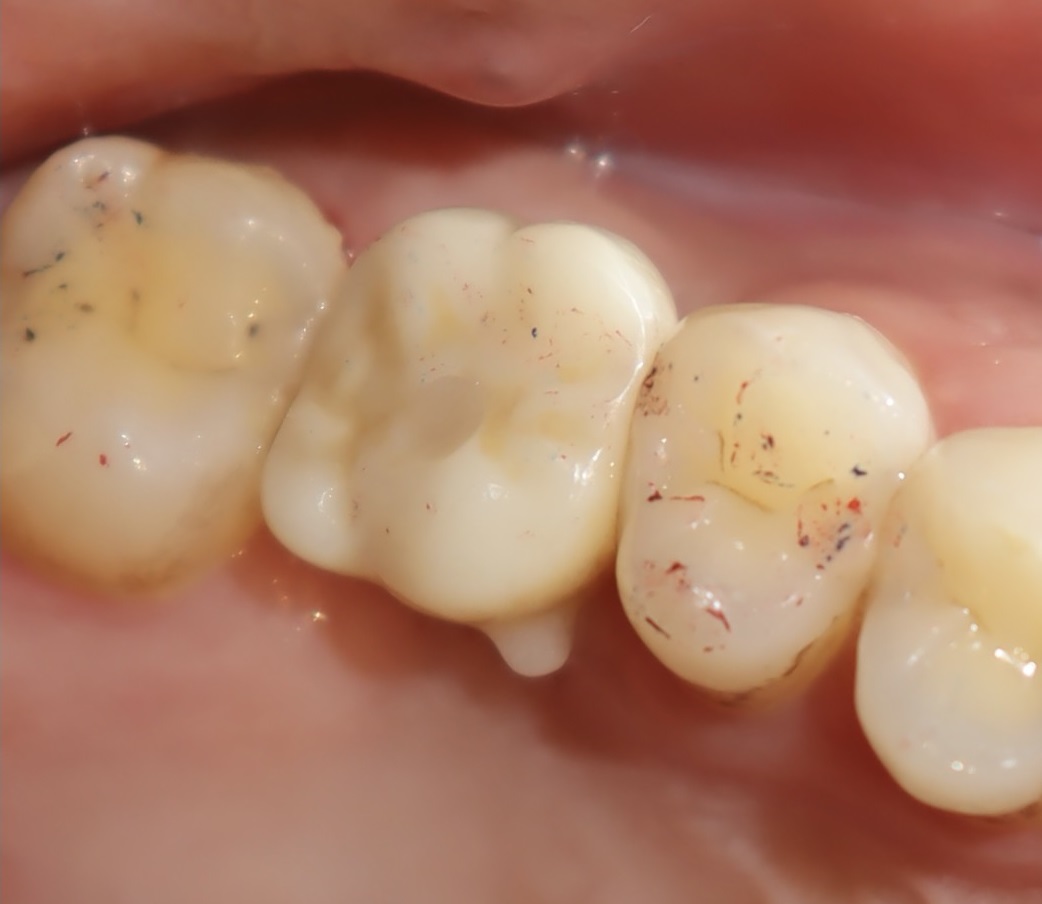 植牙合併上顎竇增高 郭子睿醫師