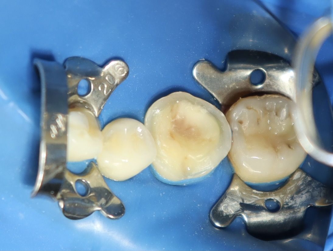 陶瓷嵌體 郭子睿醫師