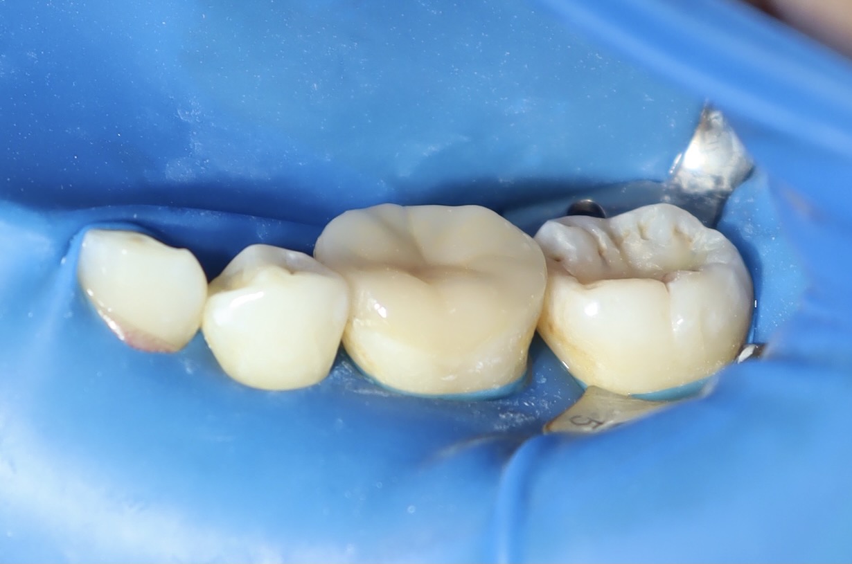 陶瓷嵌體 郭子睿醫師