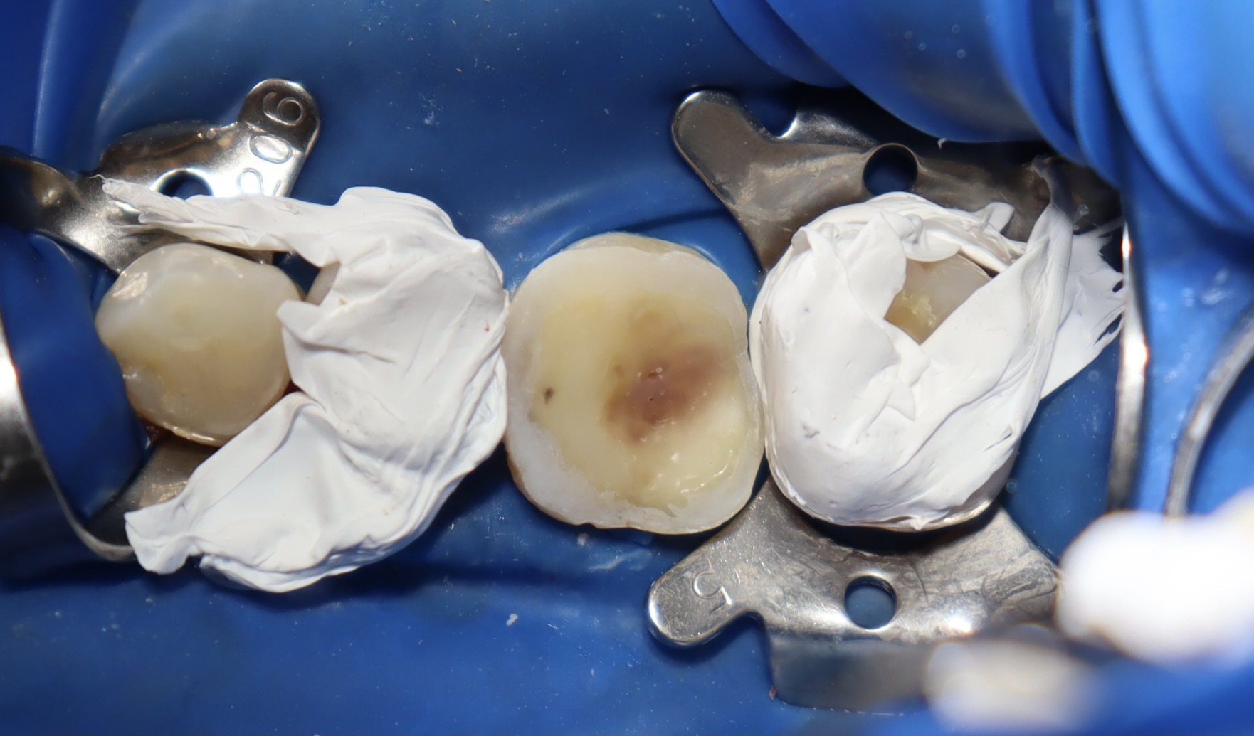 陶瓷嵌體 郭子睿醫師