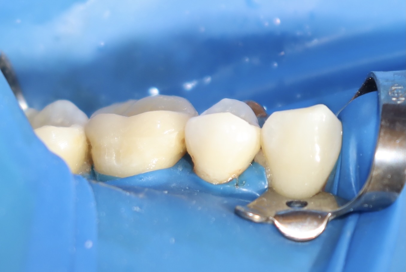 陶瓷嵌體 郭子睿醫師