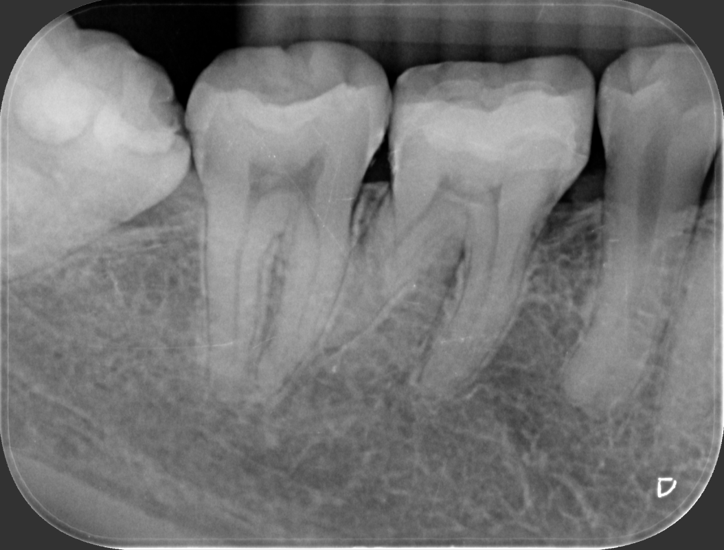 陶瓷嵌體 郭子睿醫師