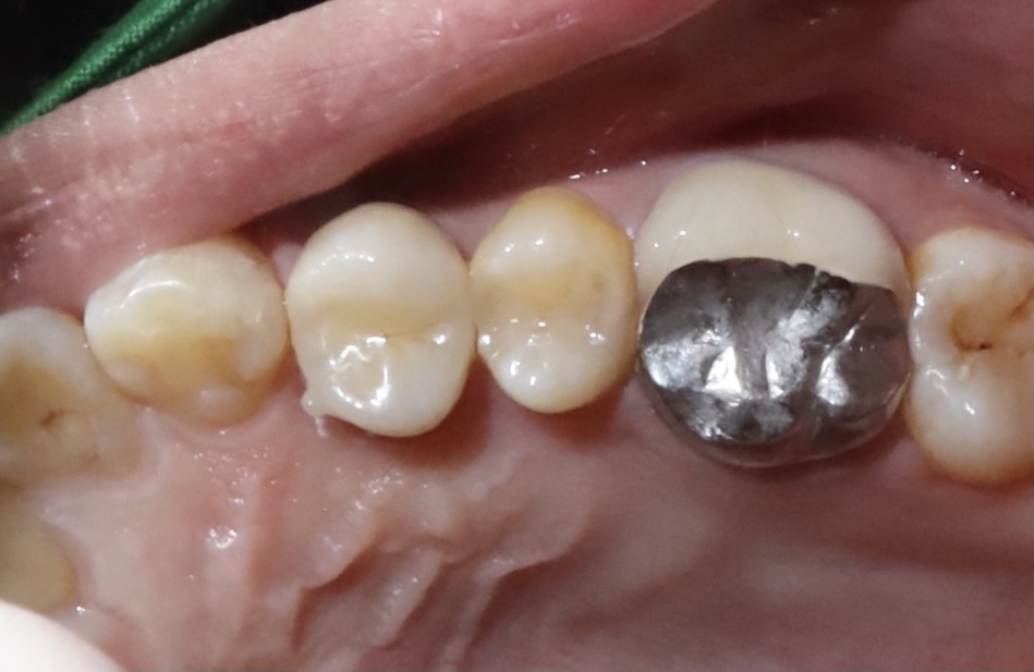 後牙全鋯冠 郭子睿醫師