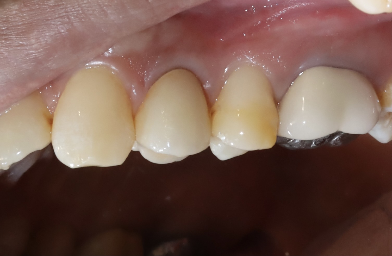 後牙全鋯冠 郭子睿醫師