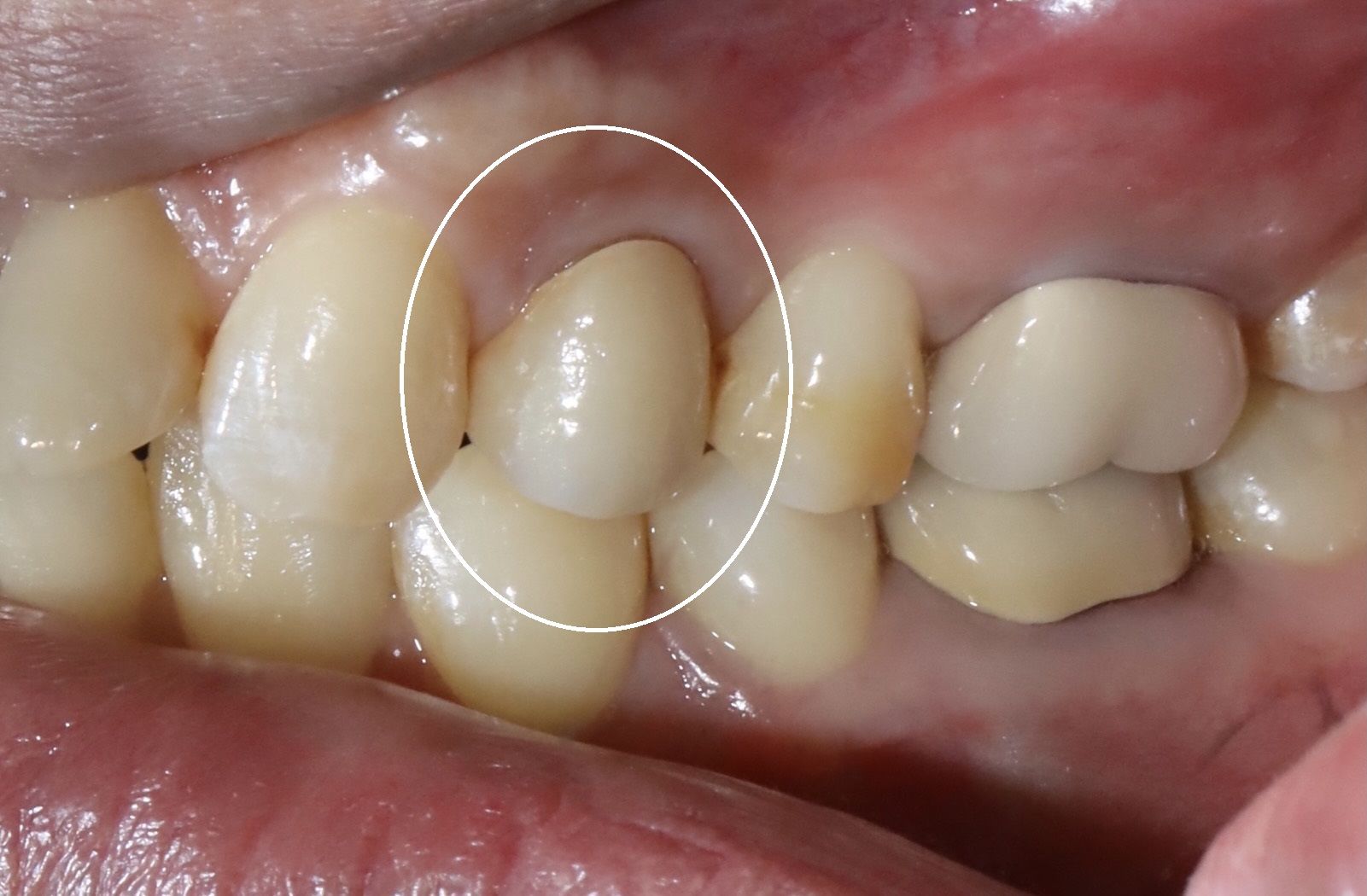 後牙全鋯冠 郭子睿醫師