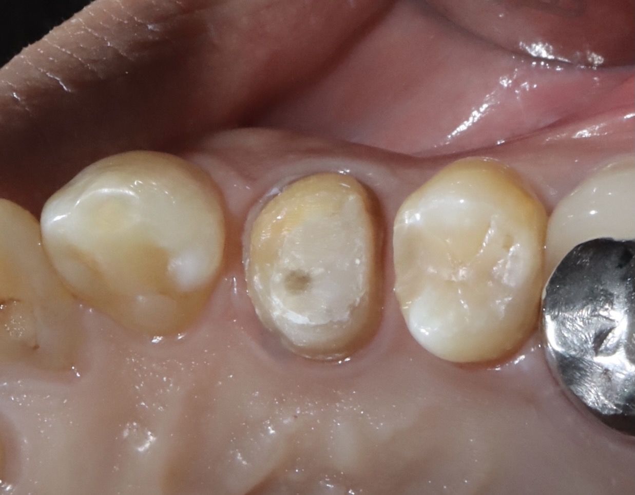 後牙全鋯冠 郭子睿醫師